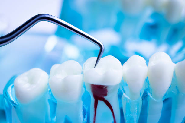 Root Canal Therapy in Richmond
